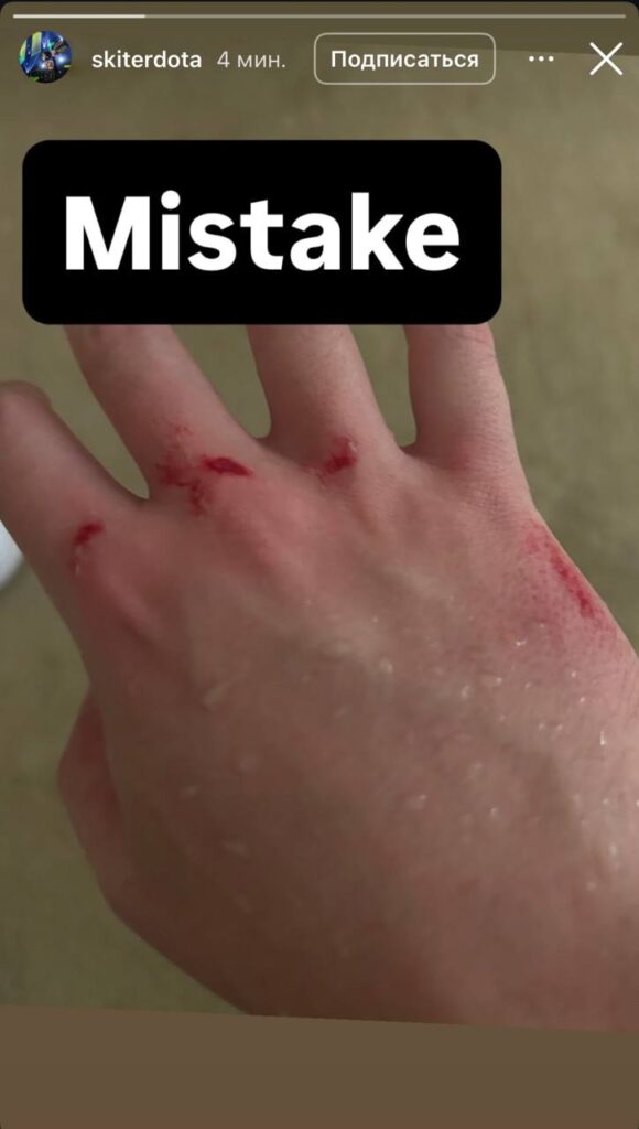 Skiter Instagram post showing hand injury